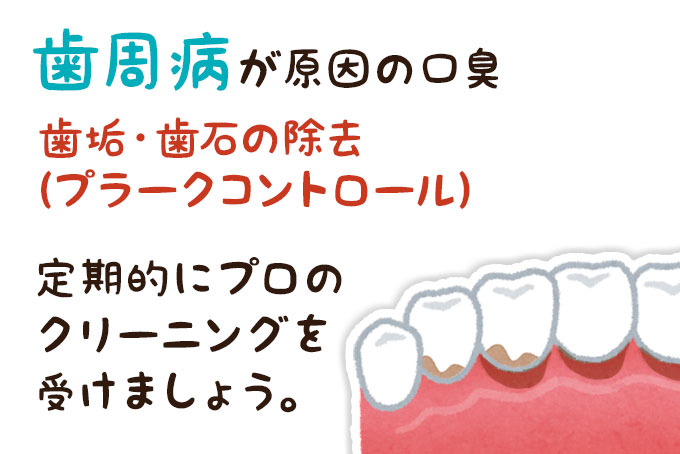 歯周病が原因の口臭治療