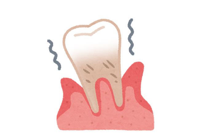 歯周病の歯