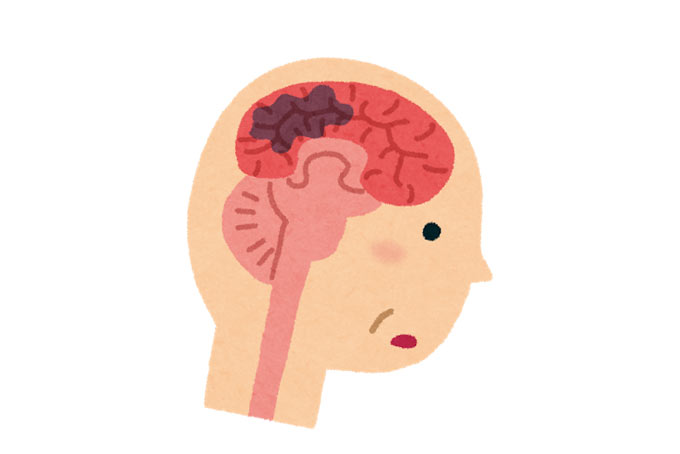 脳出血のイメージ