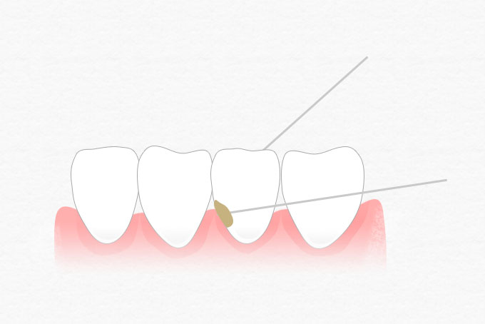 フロスを前後に動かしながら歯と歯の間を2～3回上下させて汚れを除去