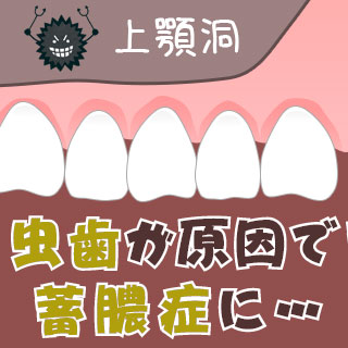 蓄膿症は虫歯が原因となるケースも！早期発見が治療の近道