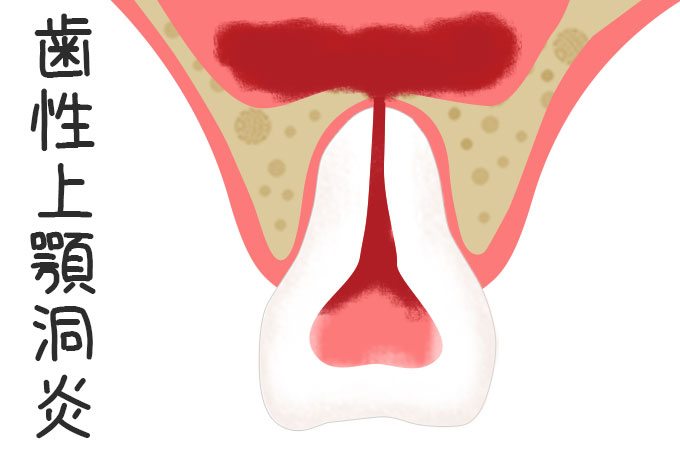 蓄膿症は虫歯が原因で起こる場合があるってホント?