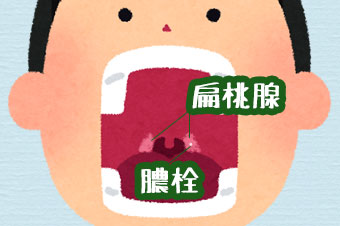 男性の口の中にある扁桃腺と膿栓の位置解説画像