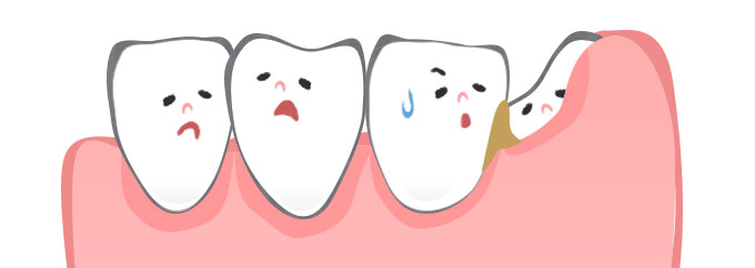 親知らずが完全に萌出していなくて歯肉が被さっている状態の場合、歯肉弁の隙間に汚れが溜まりやすくなります