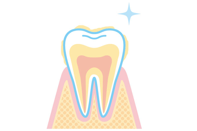 歯垢のついた歯