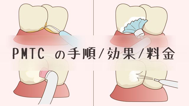 【PMTC】歯のクリーニングの手順/効果/料金/保険適用