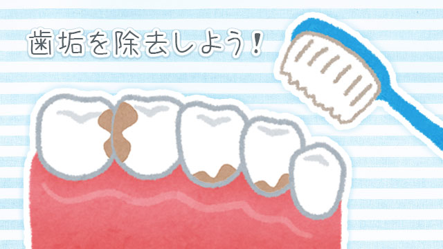 歯垢除去を徹底的に行うコツ6/歯医者クリーニングの効果