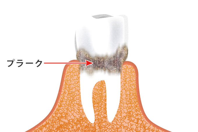 歯の隙間にこびりつくプラーク
