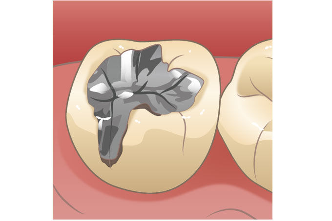 銀歯の虫歯
