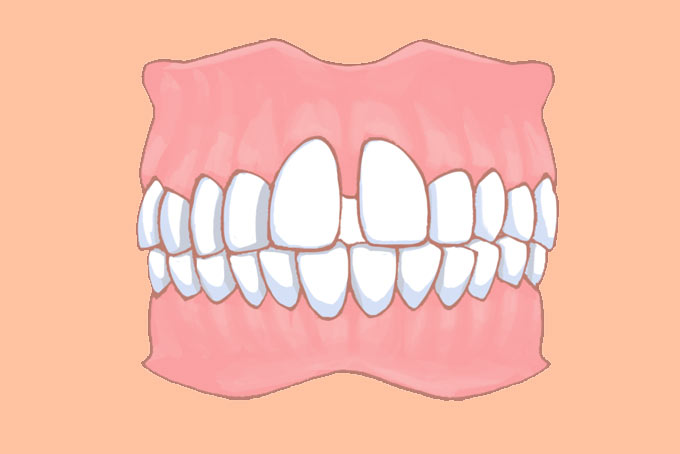 すきっ歯のイメージ